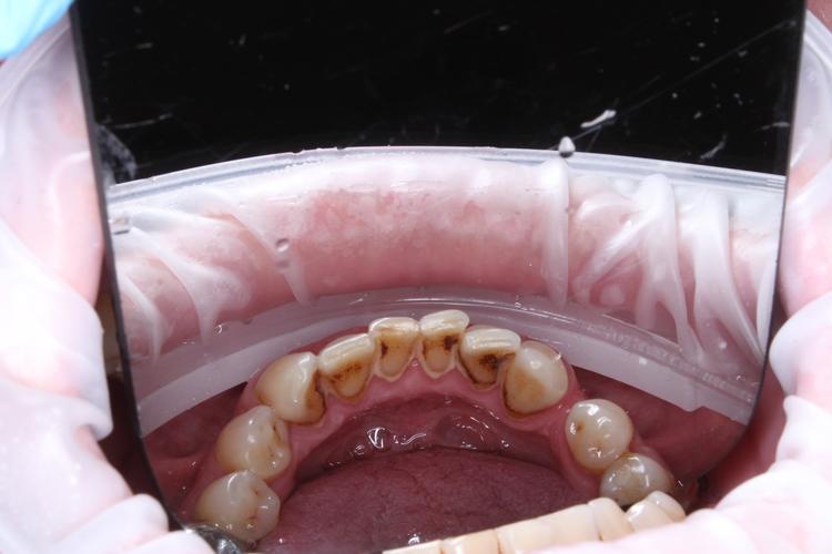 Профессиональная гигиена нижней фронтальной группы зубов фото до