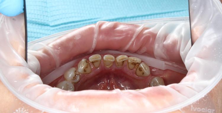 Профессиональная гигиена нижней фронтальной группы зубов фото до