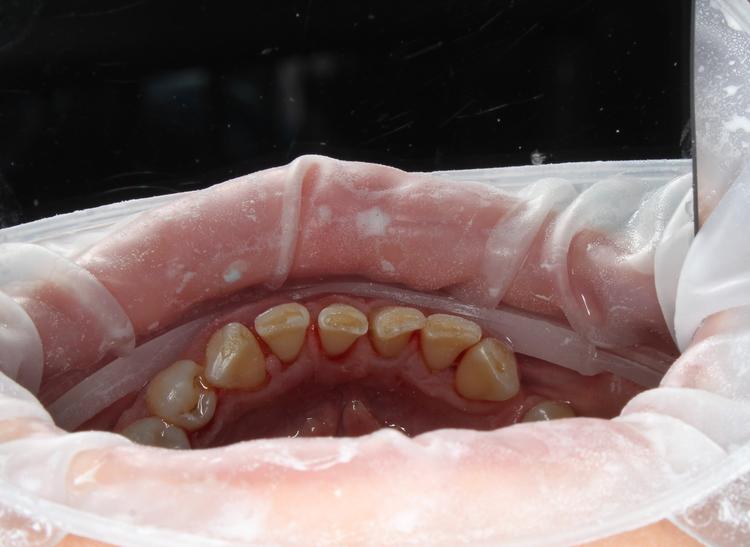 Профессиональная гигиена нижней фронтальной группы зубов фото после