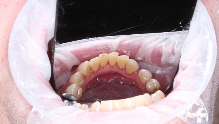 Профессиональная гигиена нижней фронтальной группы зубов фото после