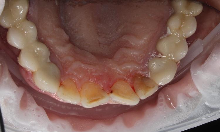 Профессиональная гигиена верхней фронтальной группы зубов фото после