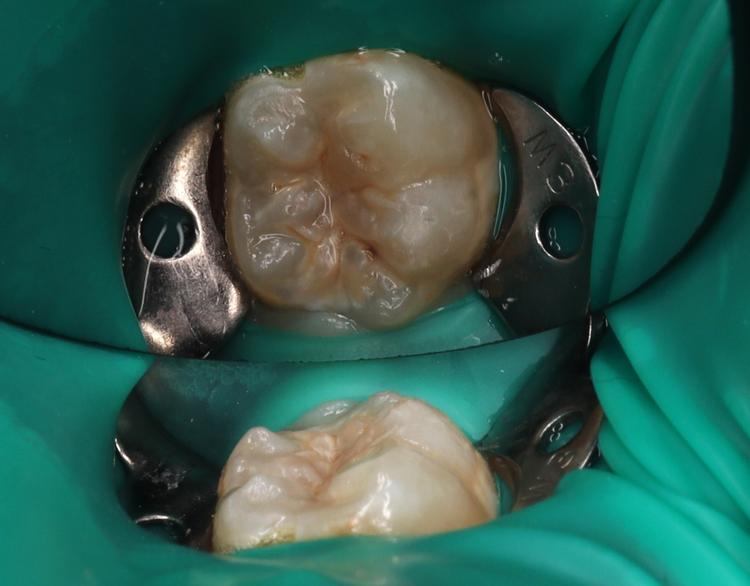 Лечение кариеса фото до