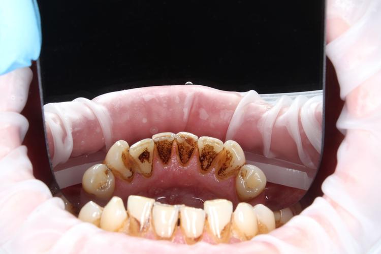 Профессиональная гигиена полости рта фото до