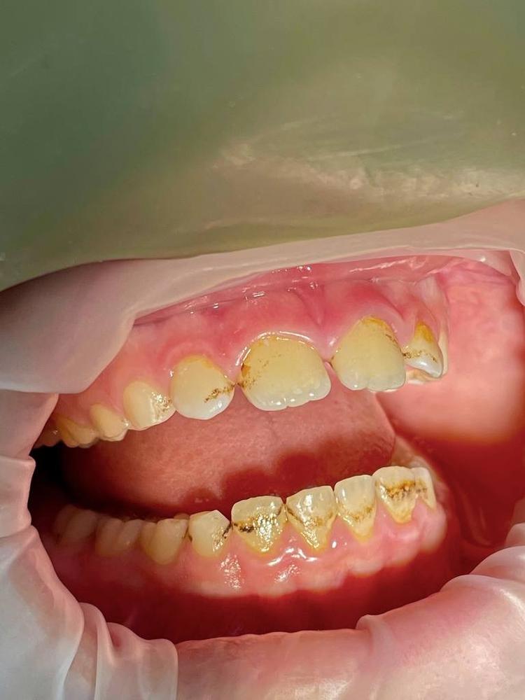 Профессиональная гигиена полости рта фото до