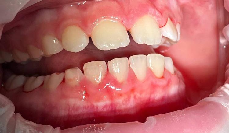 Профессиональная гигиена полости рта фото после