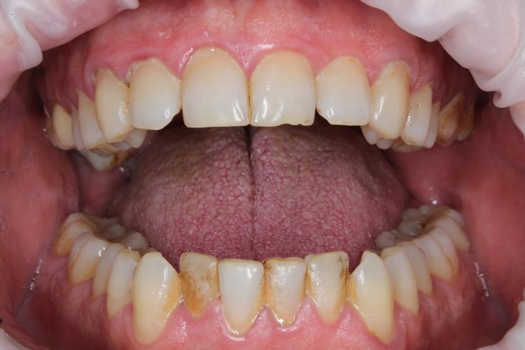 Профессиональная гигиена полости рта фото до