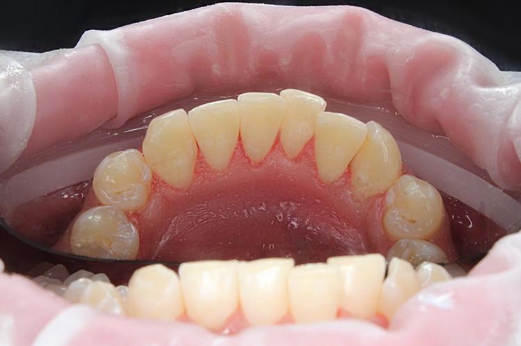 Профессиональная гигиена полости рта фото после