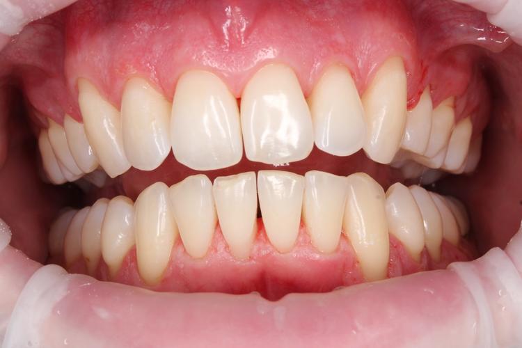 Профессиональная гигиена полости рта фото после