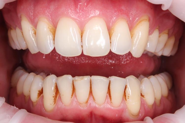 Профессиональная гигиена полости рта фото до