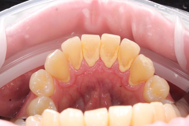 Профессиональная гигиена полости рта фото до