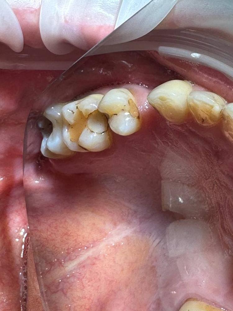 Лечение кариеса фото до