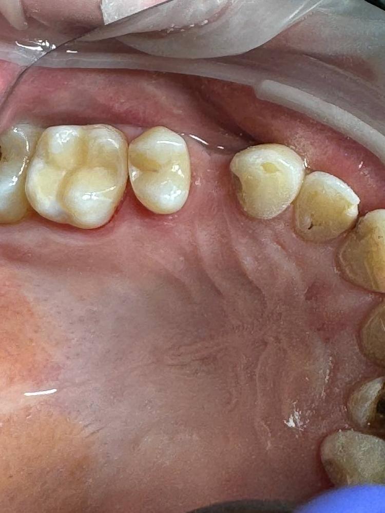 Лечение кариеса фото после