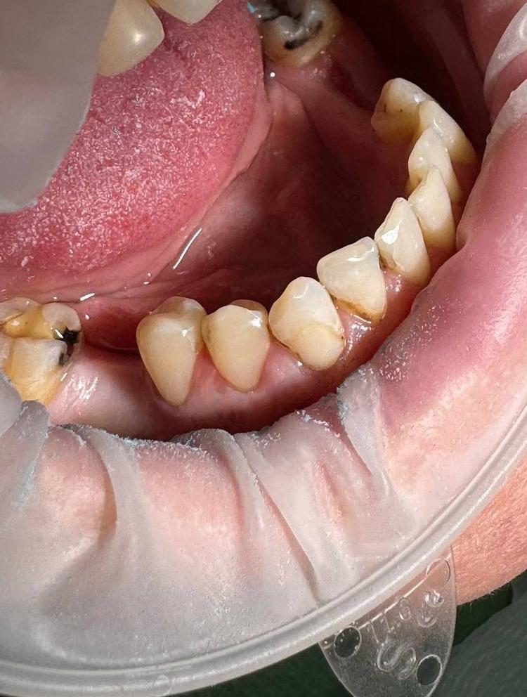 Лечение кариеса фото после