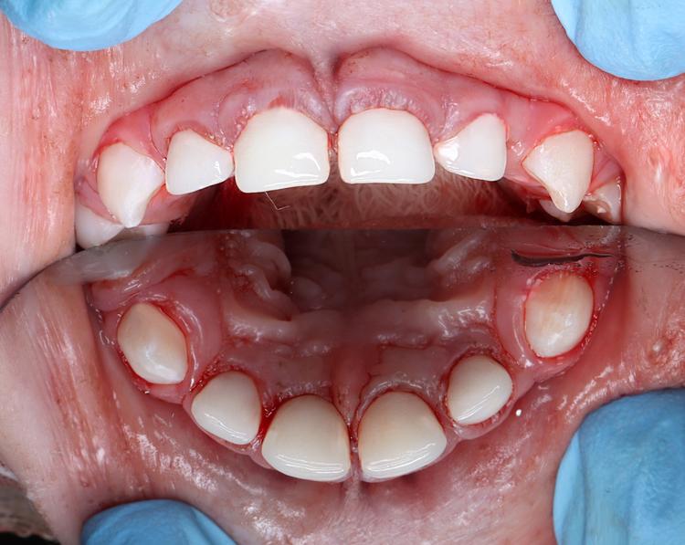 Восстановление зубов циркониевыми коронками фото после