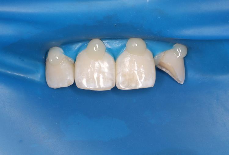 Реставрация переднего зуба фото до